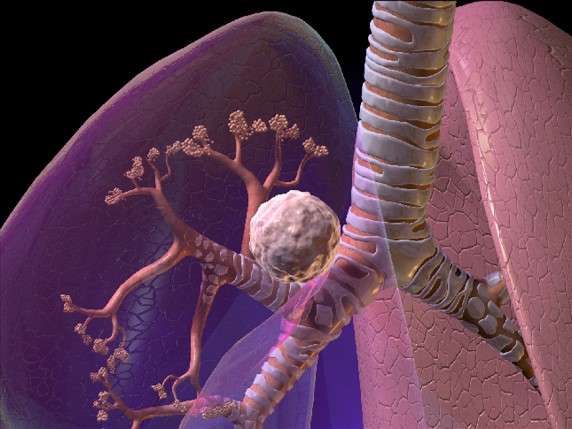 Illustration of lung cancer.