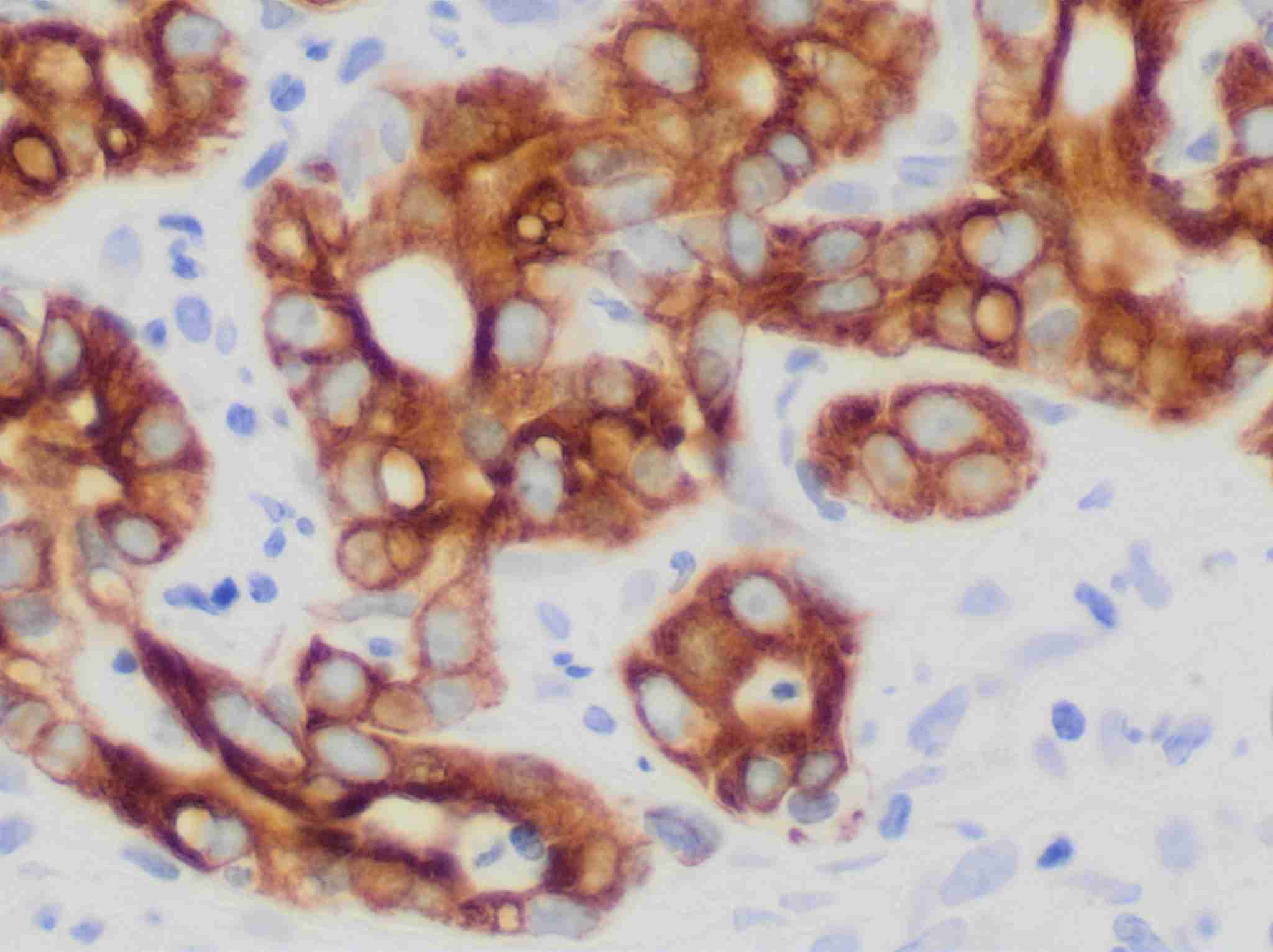 Fig.1 Immunohistochemistry. (By Mikael Häggström, M.D. - Own work, CC0, https://commons.wikimedia.org/wiki/File:Immunohistochemistry_for_CK19_in_metastatic_cholangiocarcinoma_to_the_liver.jpg)